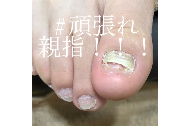 巻き爪ケア 大阪 天王寺 巻き爪について サロンからのお得な情報や新しいデザインを配信 巻き爪なら大阪のprivate Salon Gratisへ