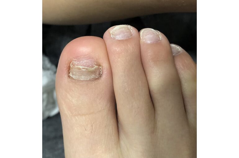 フットケア 巻き爪 大阪 天王寺 巻き爪について サロンからのお得な情報や新しいデザインを配信 巻き爪なら大阪のprivate Salon Gratisへ