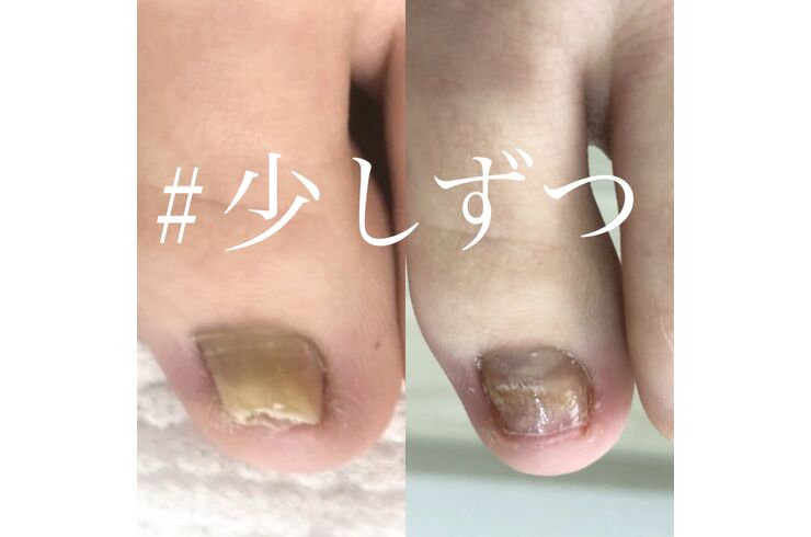 巻き爪なら大阪のprivate Salon Gratisへ 高技術